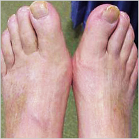 charcot foot images